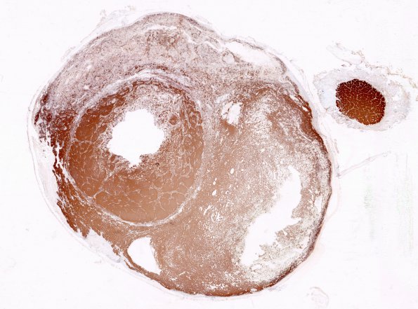 7B3 Astrocytoma, pilocytic, optic nerve (Case 7) GFAP WM