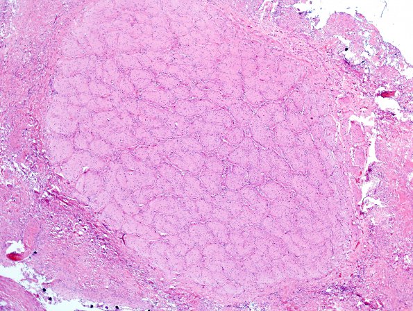 7C1 Astrocytoma, pilocytic, optic nerve (Case 7) H&E 3.jpg