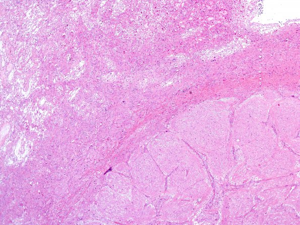 7C2 Astrocytoma, pilocytic, optic nerve (Case 7) H&E 5.jpg