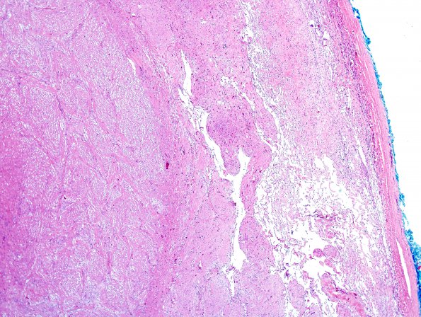 7C3 Astrocytoma, pilocytic, optic nerve (Case 7) H&E 4.jpg