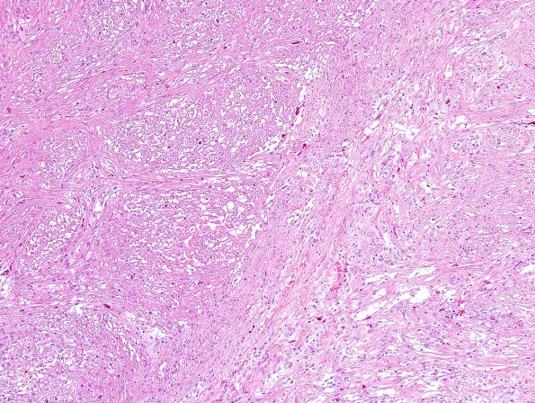 7C4 Astrocytoma, pilocytic, optic nerve (Case 7) H&E 1.jpg