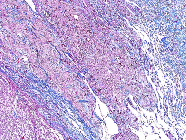 7D1 Astrocytoma, pilocytic, optic nerve (Case 7) Trichrome 2.jpg
