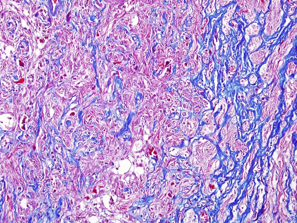 7D2 Astrocytoma, pilocytic, optic nerve (Case 7) Trichrome 4.jpg