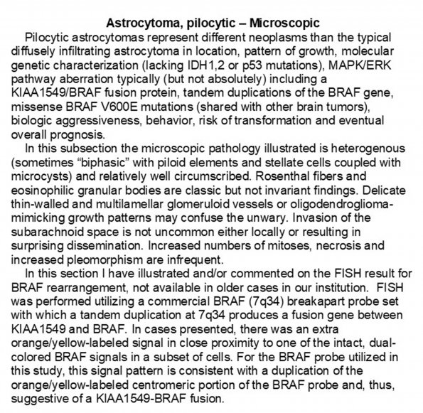 0A Astrocytoma, pilocytic, Microscopic - Text A