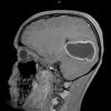 10A1 Astrocytoma, pilocytic (Case 10) T1W 2 - Copy