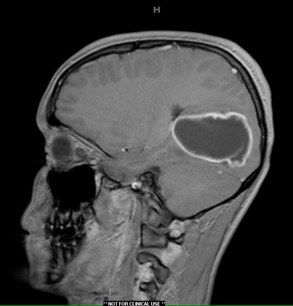 10A1 Astrocytoma, pilocytic (Case 10) T1W 2 - Copy