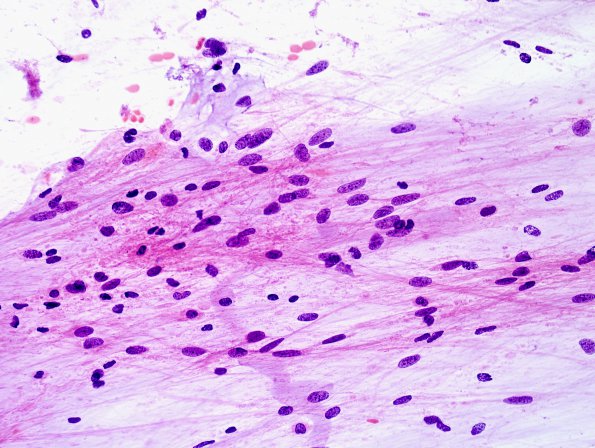 10B1 Astrocytoma, pilocytic (Case 10) H&E smear 1