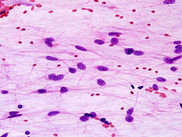 10B2 Astrocytoma, pilocytic (Case 10) H&E smear 2