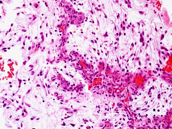 10C1 Astrocytoma, pilocytic (Case 10) H&E 9