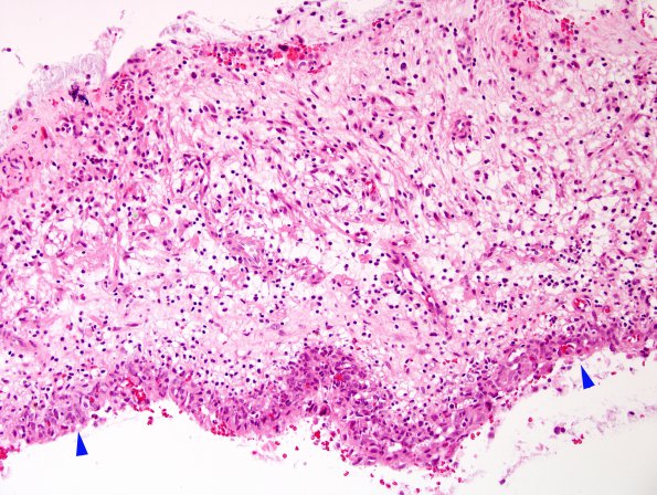 10C2 Astrocytoma, pilocytic (Case 10) H&E 4 copy