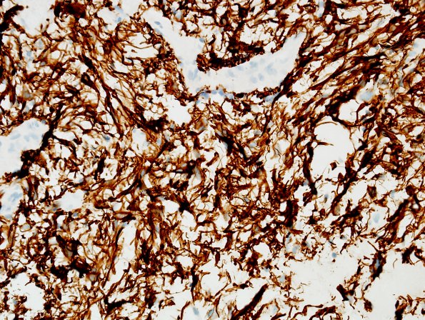 10D Astrocytoma, pilocytic (Case 10) GFAP 4