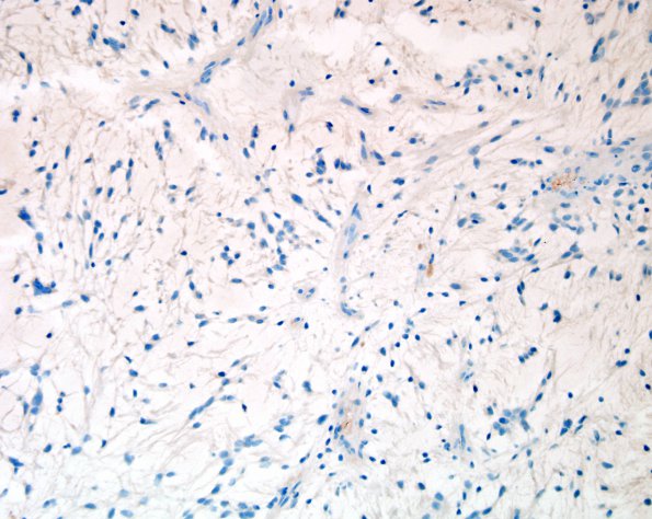 10E Astrocytoma, pilocytic (Case 10) NF 2