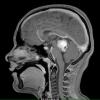 11A Astrocytoma, pilocytic (Case 11) T1 W1 - Copy