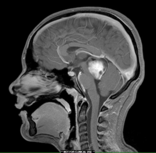 11A Astrocytoma, pilocytic (Case 11) T1 W1 - Copy