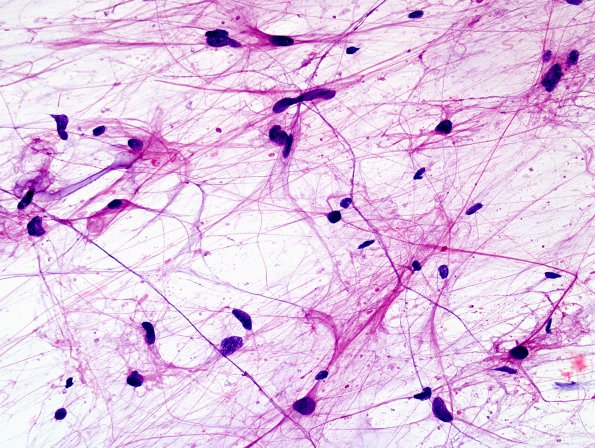 11B Astrocytoma, pilocytic, BRAF fusion (Case 11) H&E smear 2