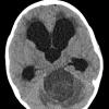 12A1 Astrocytoma, pilocytic (Case 12) CT 1 - Copy