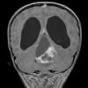 12A2 Astrocytoma, pilocytic (Case 12) T1 with contrast 3 - Copy