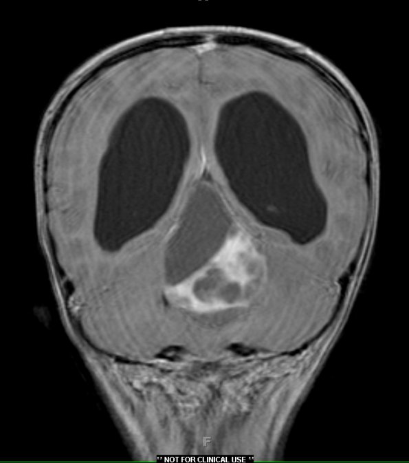 12A2 Astrocytoma, pilocytic (Case 12) T1 with contrast 3 - Copy