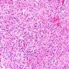 12B1 Astrocytoma, pilocytic (Case 12) H&E oligo area 1