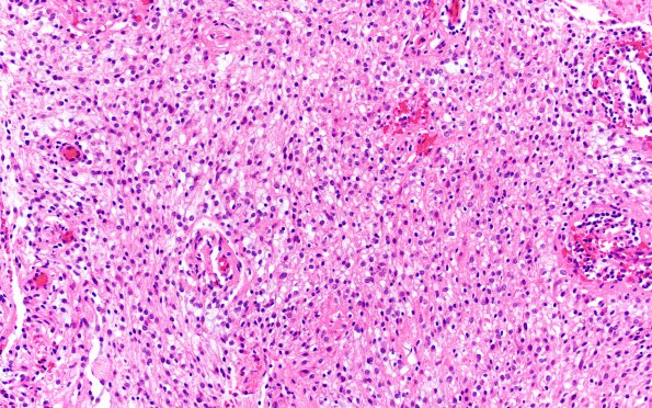 12B1 Astrocytoma, pilocytic (Case 12) H&E oligo area 1