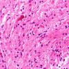 12B2 Astrocytoma, pilocytic (Case 12) H&E 1