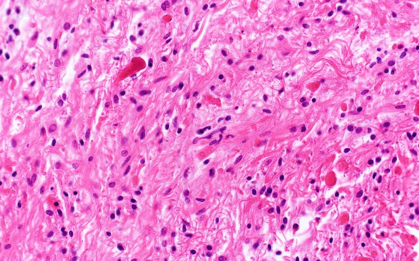 12B2 Astrocytoma, pilocytic (Case 12) H&E 1