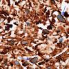 12C2 Astrocytoma, pilocytic (Case 12) Rosenthal fibers GFAP 6 copyA