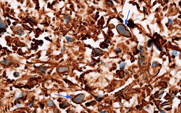 12C2 Astrocytoma, pilocytic (Case 12) Rosenthal fibers GFAP 6 copyA