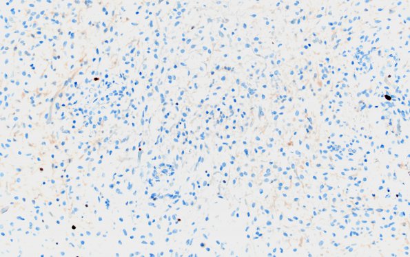 12D Astrocytoma, pilocytic (Case 12) Ki67