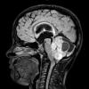 13A1 Astrocytoma, pilocytic (Case 13) T2 FLAIR 2 - Copy