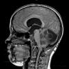 13A2 Astrocytoma, pilocytic (Case 13) T1 1 - Copy