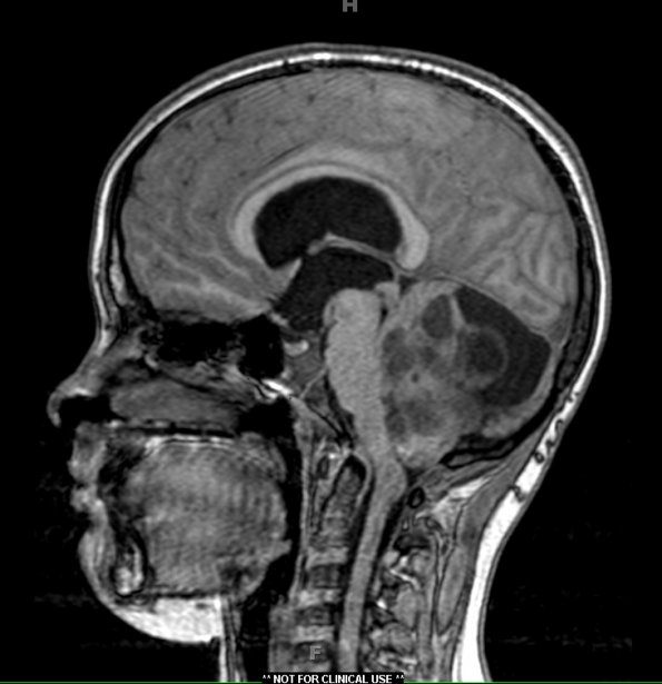 13A2 Astrocytoma, pilocytic (Case 13) T1 1 - Copy