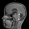 13A3 Astrocytoma, pilocytic (Case 13) T1 W 3 - Copy