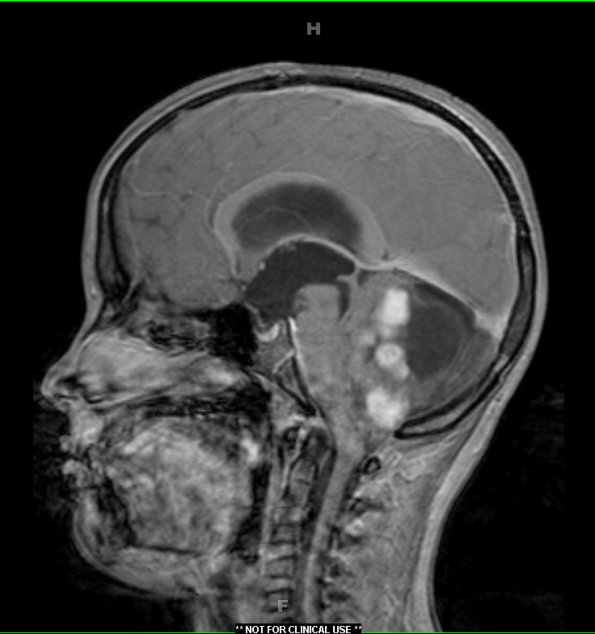 13A3 Astrocytoma, pilocytic (Case 13) T1 W 3 - Copy