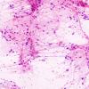 13B1 Astrocytoma, pilocytic (Case 13) smear H&E