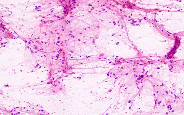 13B1 Astrocytoma, pilocytic (Case 13) smear H&E