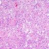 13B2 Astrocytoma, pilocytic (Case 13) H&E 4