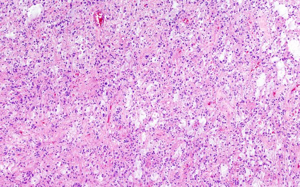 13B2 Astrocytoma, pilocytic (Case 13) H&E 4