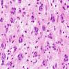 13B3 Astrocytoma, pilocytic (Case 13) H&E 3