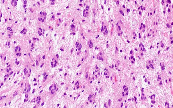 13B3 Astrocytoma, pilocytic (Case 13) H&E 3