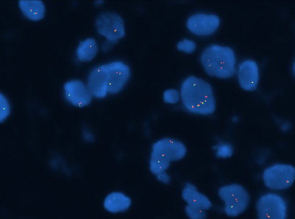 13C Astrocytoma, pilocytic (Case 13) BRAF fusion - Copy