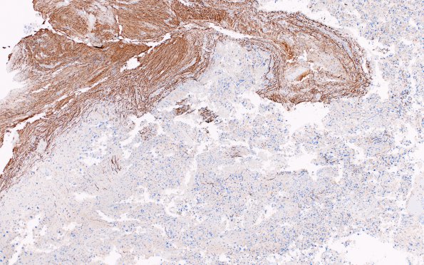 13D Astrocytoma, pilocytic (Case 13) NF