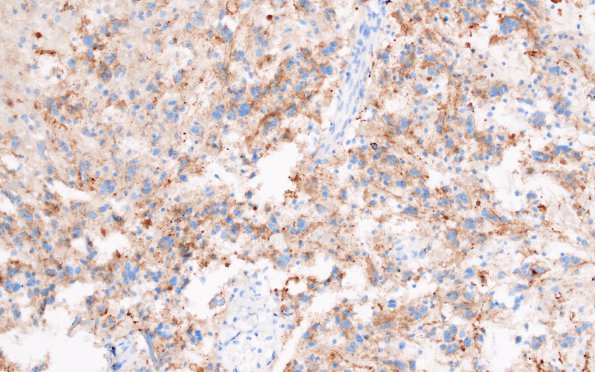 13E Astrocytoma, pilocytic (Case 13) SYNaptophysin