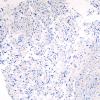 13F Astrocytoma, pilocytic (Case 13) H3K27M