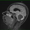 14A1 Astrocytoma, pilocytic (Case 14) T2 FLAIR 1 - Copy