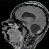 14A2 Astrocytoma, pilocytic (Case 14) T1 with contrast 4 - Copy