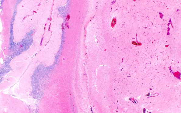 14B1 Astrocytoma, pilocytic (Case 14) H&E 1