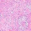 14B2 Astrocytoma, pilocytic (Case 14) H&E 6