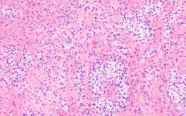 14B2 Astrocytoma, pilocytic (Case 14) H&E 6