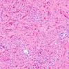 14B3 Astrocytoma, pilocytic (Case 14) H&E 9